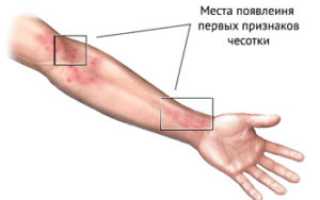 Чесотка фото на руках у взрослых